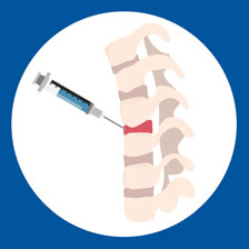 Spinal Anesthesia Instagram