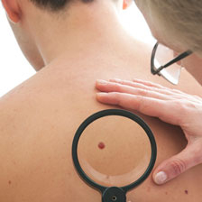 magnifying glass looking at a mole