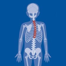 skeleton showing scoliosis
