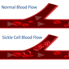 blood vessels of normal and sickle cell