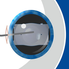 eye receiving ICL