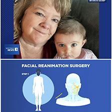 Rhonda Darby and grandchild - graphic of facial reanimation surgery