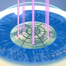 animation of laser breaking up a cataract on an eyeball