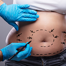 a person with blue gloves and a marker making marks on someone's stomach area