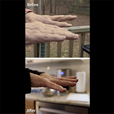 Mary Smith holding her hands straight out in front to demonstrate her hands shaking and not