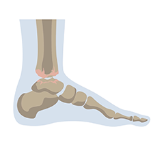 Ankle arthritis video