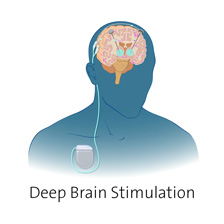 visual of a DBS devise