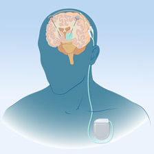 Animation of dbs implant