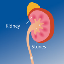An animated image of the kidney with a stone inside