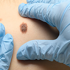 Medical professional examines a mole