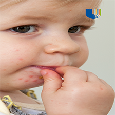 Hand, Foot, and Mouth Disease