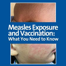 picture of measles